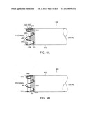 GASTROINTESTINAL IMPLANT WITH DRAWSTRING diagram and image