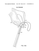 GASTROINTESTINAL IMPLANT WITH DRAWSTRING diagram and image