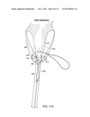 GASTROINTESTINAL IMPLANT WITH DRAWSTRING diagram and image