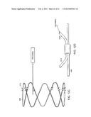 GASTROINTESTINAL IMPLANT WITH DRAWSTRING diagram and image