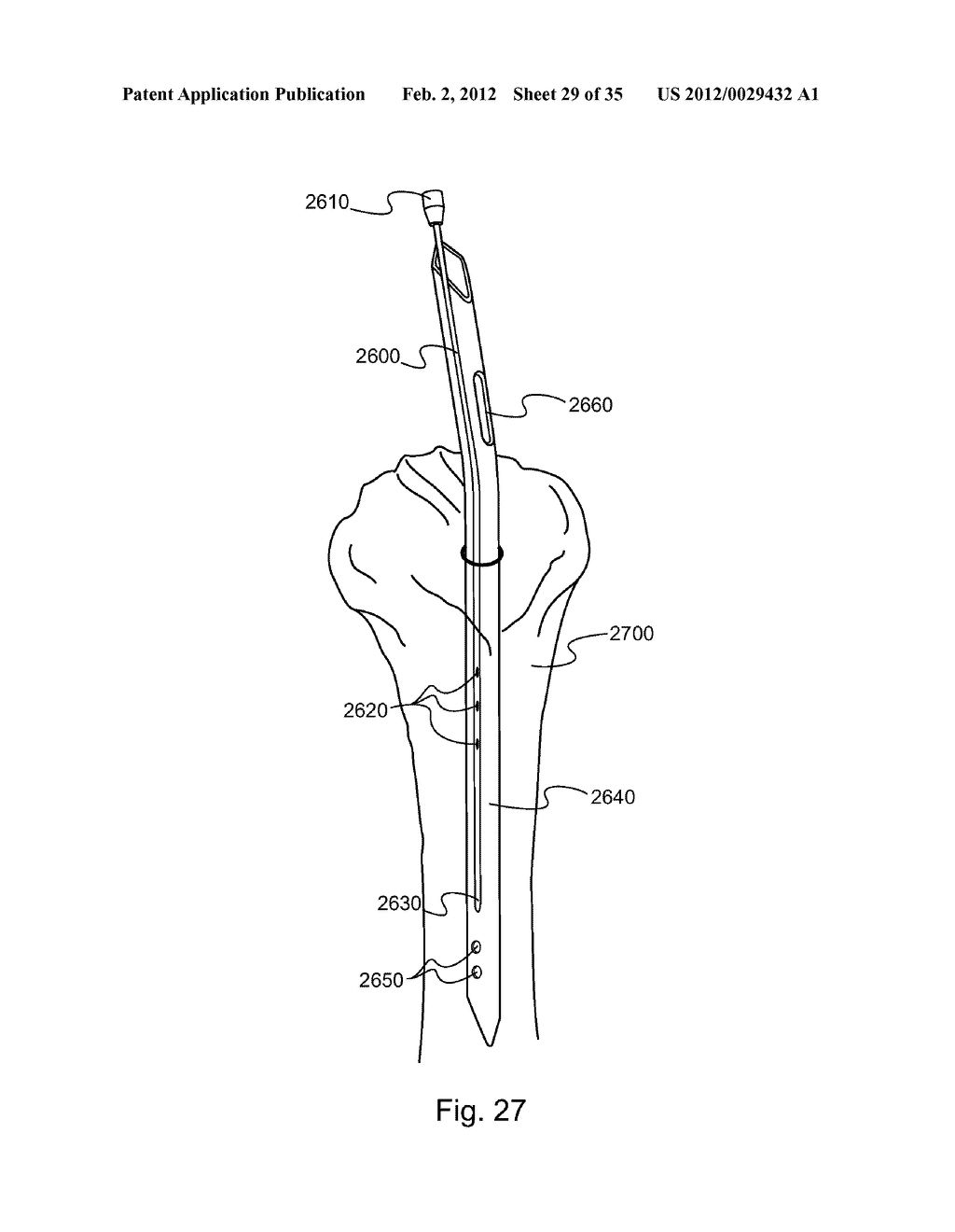 METHOD AND DEVICE FOR DELIVERING MEDICINE TO BONE - diagram, schematic, and image 30