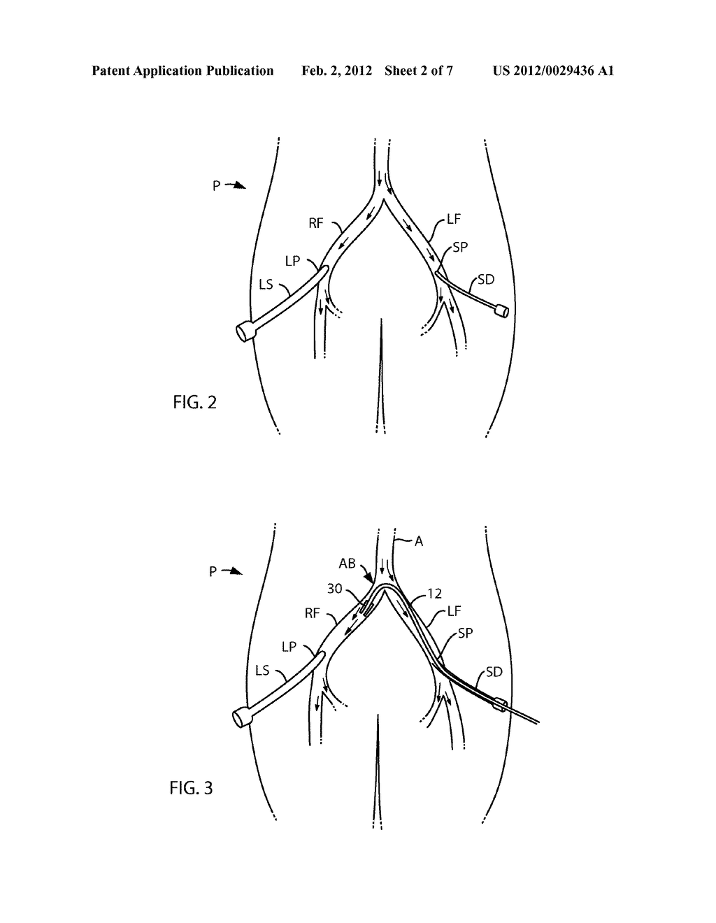 BILATERAL VESSEL CLOSURE - diagram, schematic, and image 03