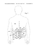 REDUCED-PRESSURE, COMPRESSION SYSTEMS AND APPARATUSES FOR USE ON A CURVED     BODY PART diagram and image