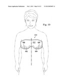 REDUCED-PRESSURE, COMPRESSION SYSTEMS AND APPARATUSES FOR USE ON A CURVED     BODY PART diagram and image