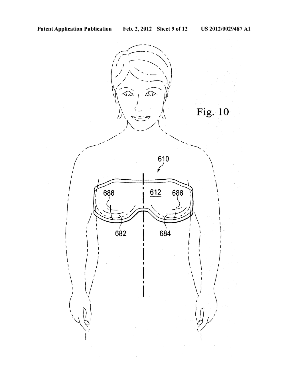 REDUCED-PRESSURE, COMPRESSION SYSTEMS AND APPARATUSES FOR USE ON A CURVED     BODY PART - diagram, schematic, and image 10