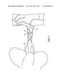 ENDOLUMINAL ABLATION CRYOBALLOON AND METHOD diagram and image