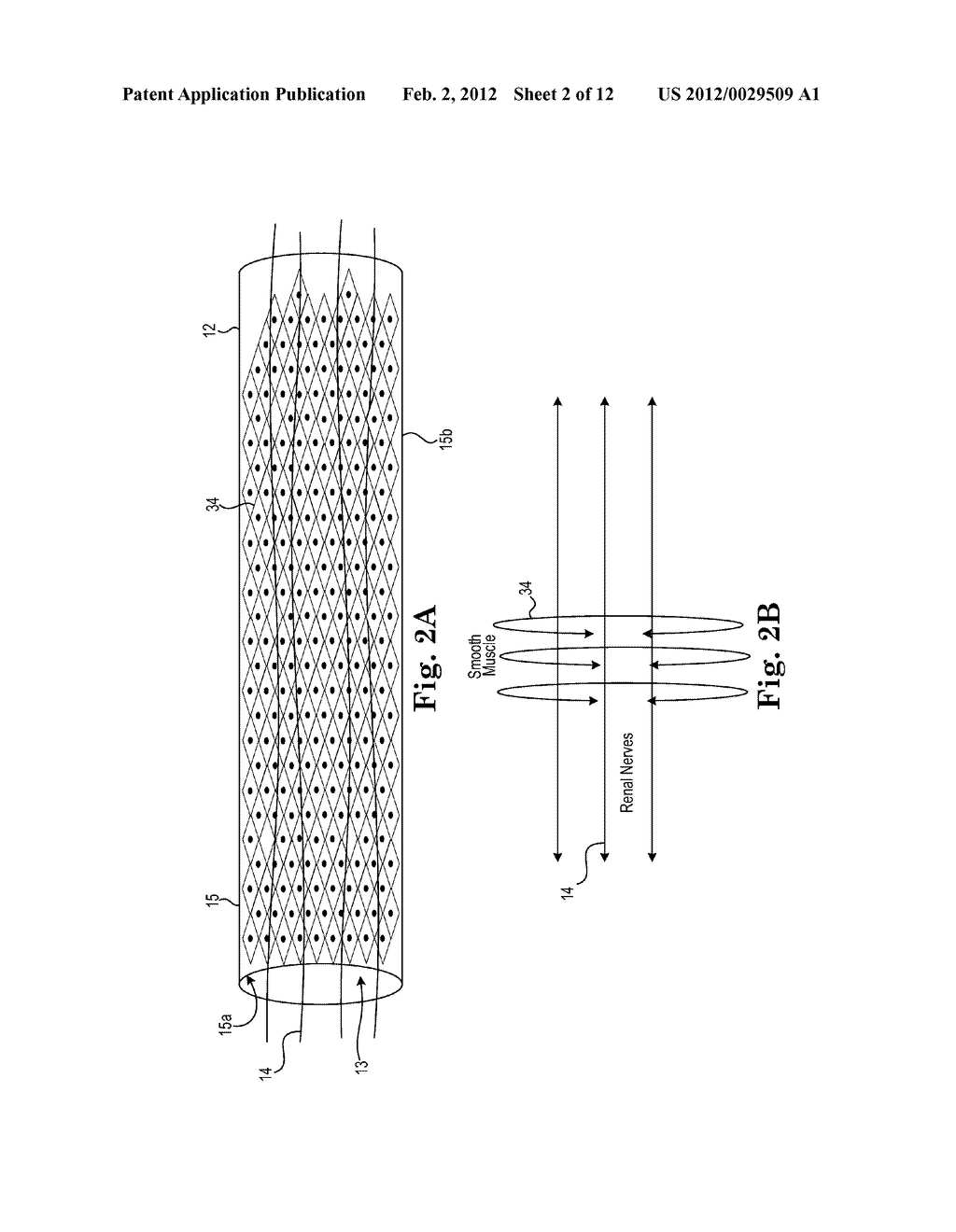 Spiral Balloon Catheter for Renal Nerve Ablation - diagram, schematic, and image 03