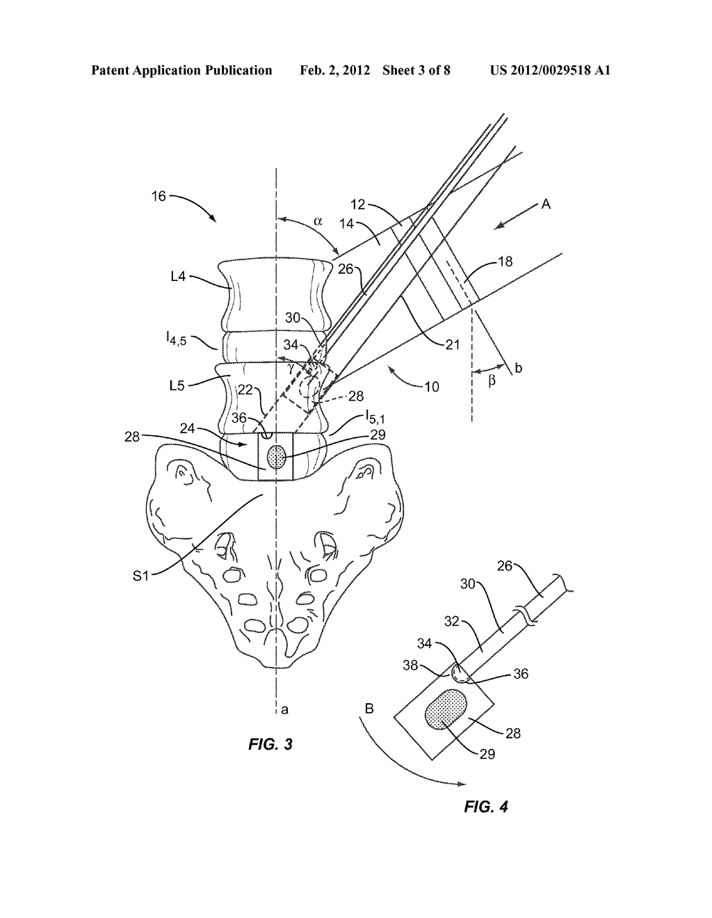 LUMBO-SACRAL IMPLANT SYSTEM AND METHOD - diagram, schematic, and image 04