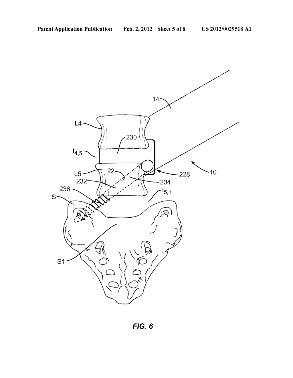 LUMBO-SACRAL IMPLANT SYSTEM AND METHOD - diagram, schematic, and image 06