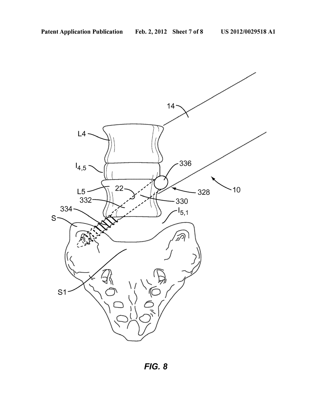 LUMBO-SACRAL IMPLANT SYSTEM AND METHOD - diagram, schematic, and image 08