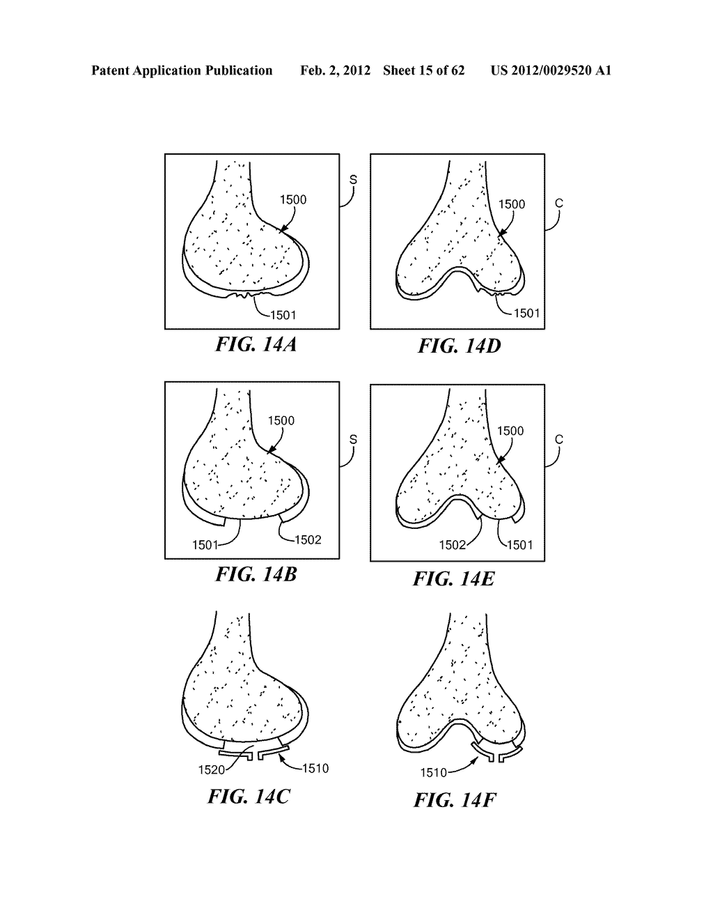 Patient Selectable Joint Arthroplasty Devices and Surgical Tools - diagram, schematic, and image 16