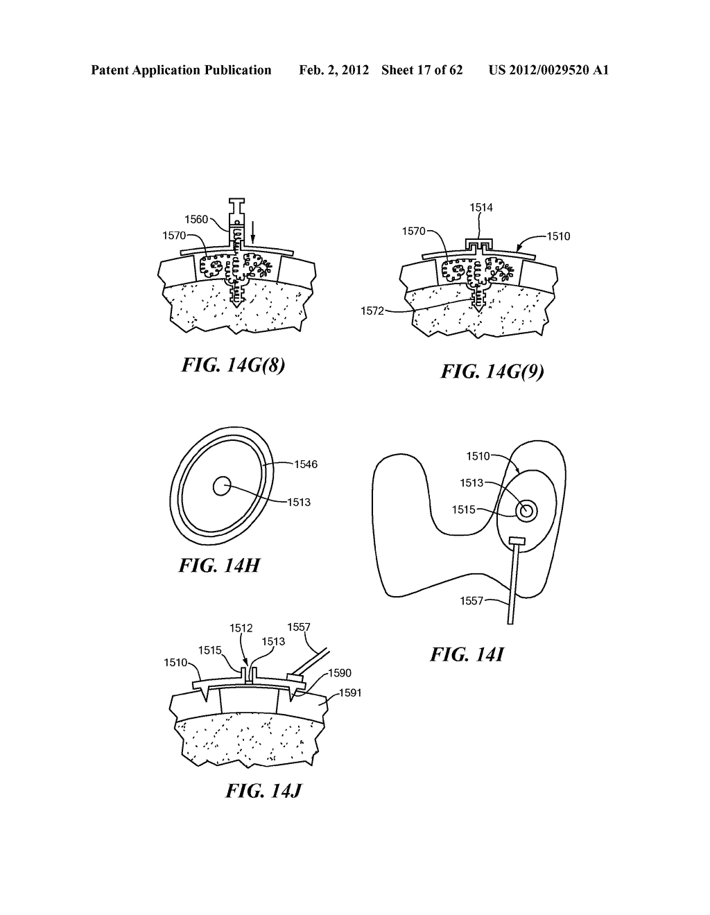 Patient Selectable Joint Arthroplasty Devices and Surgical Tools - diagram, schematic, and image 18