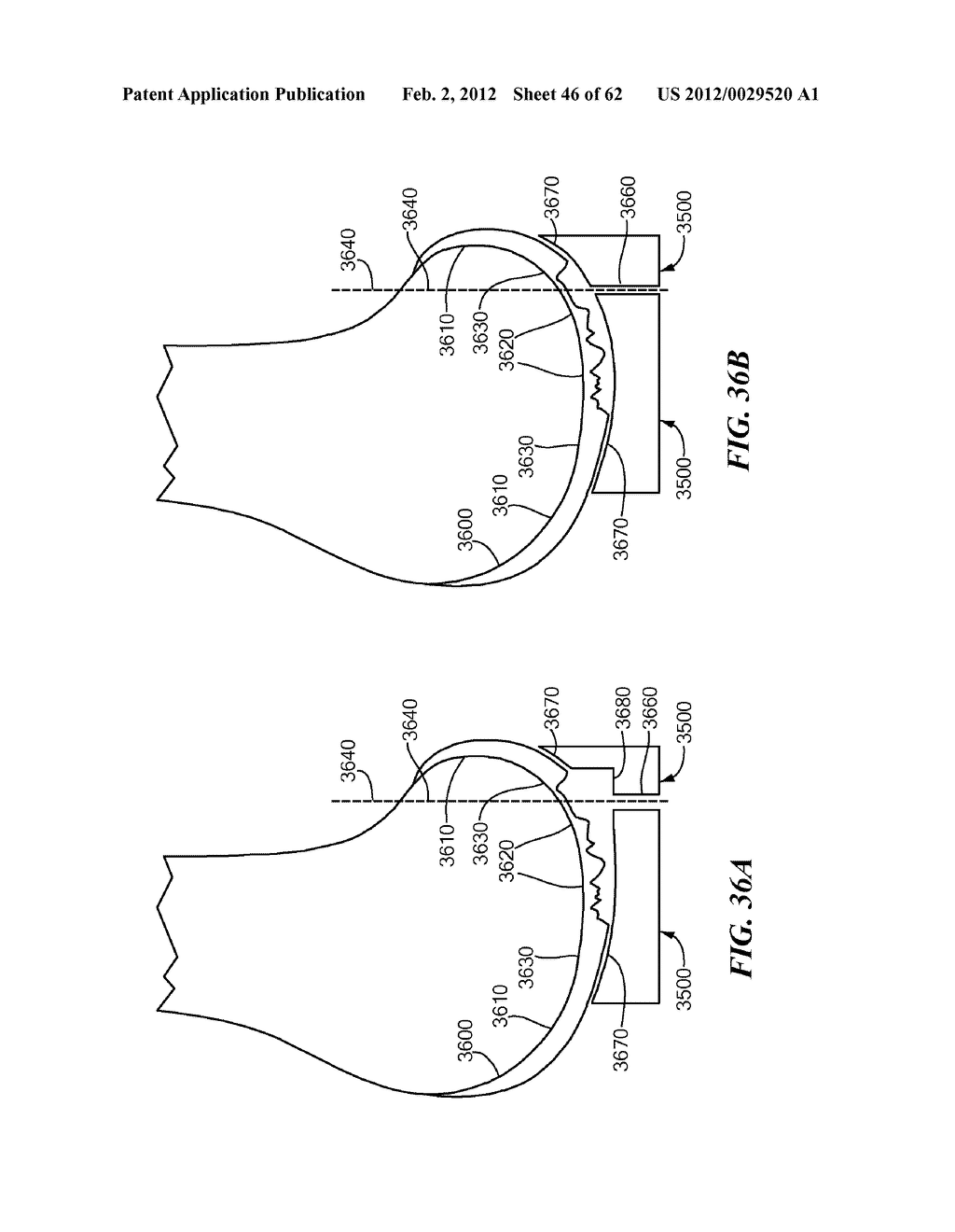 Patient Selectable Joint Arthroplasty Devices and Surgical Tools - diagram, schematic, and image 47