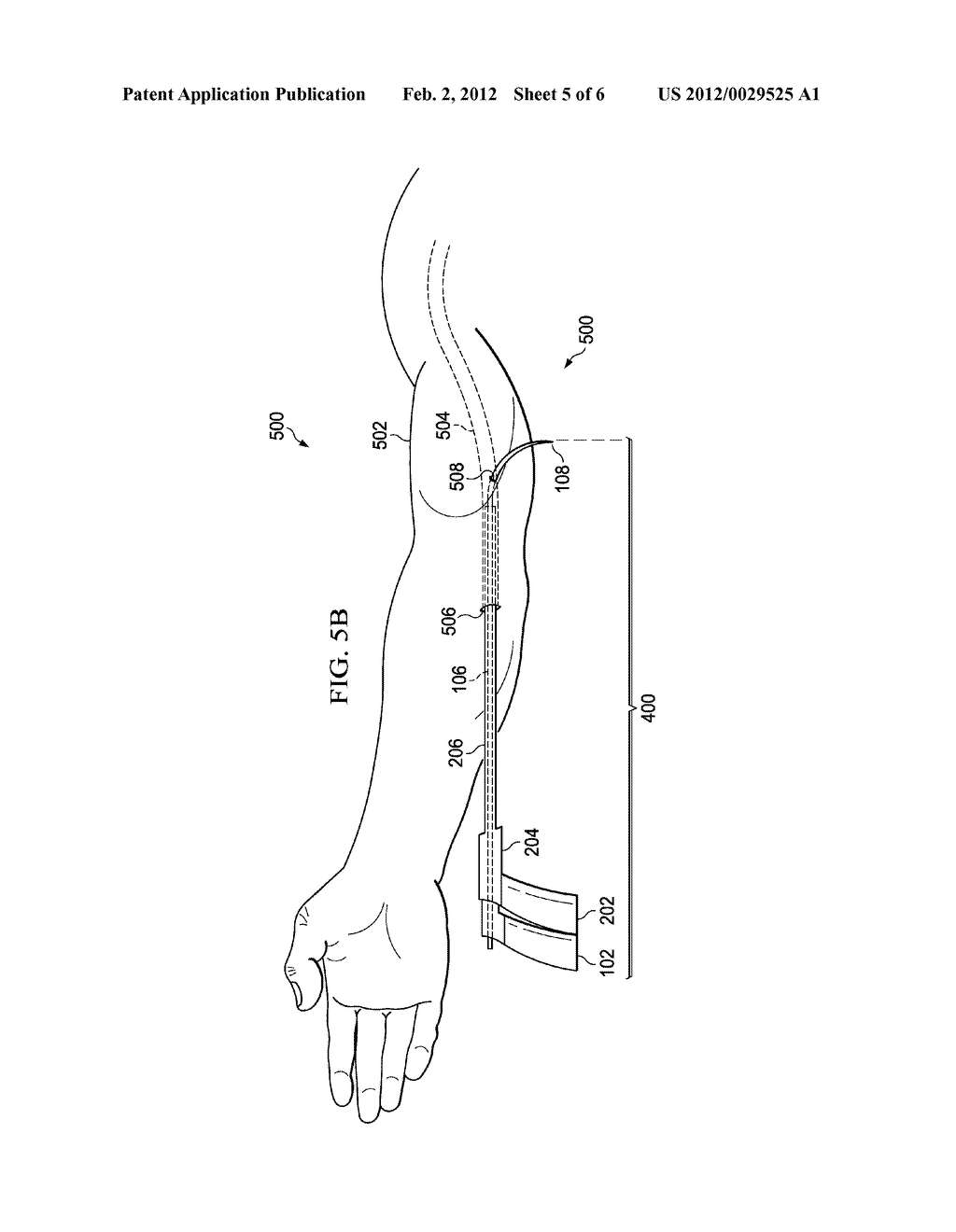 MEDICAL DEVICE AND METHOD FOR VASCULAR ACCESS - diagram, schematic, and image 06