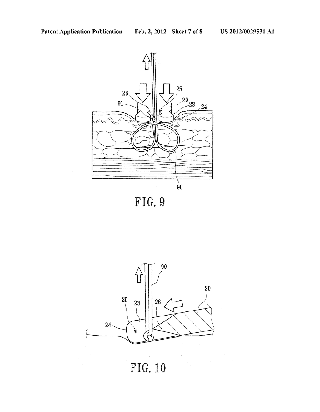 SUTURE CUT-OFF STRUCTURE FOR SUBCUTANEOUS STITCHING OPERATION - diagram, schematic, and image 08