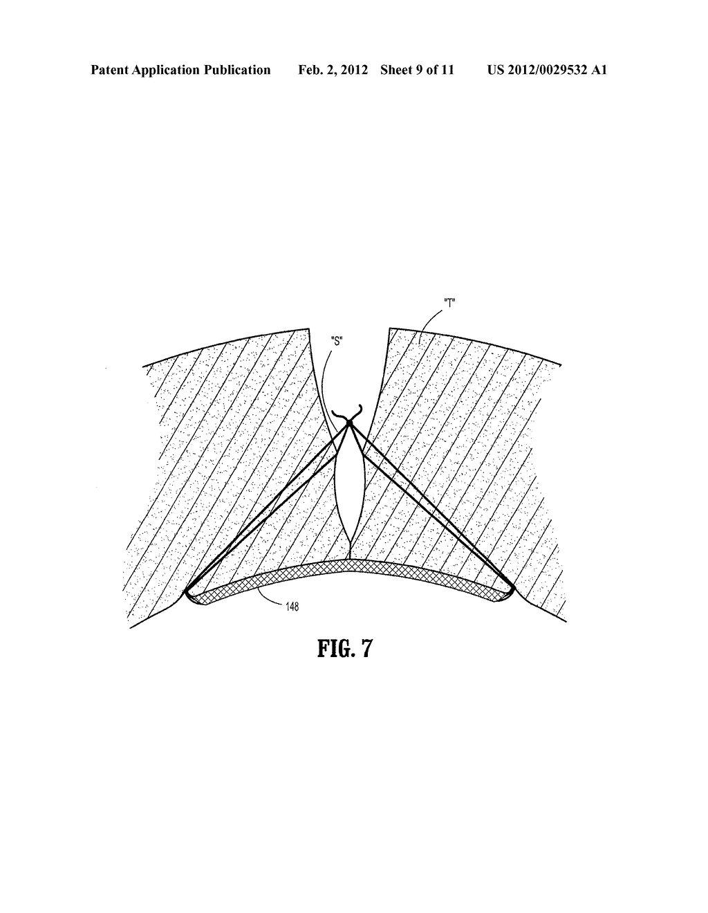 Wound Closure Device Including Mesh Barrier - diagram, schematic, and image 10