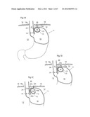 APPARATUS FOR TREATING GERD diagram and image