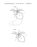 APPARATUS FOR TREATING GERD diagram and image