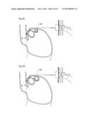 APPARATUS FOR TREATING GERD diagram and image