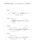 APPARATUS FOR TREATING GERD diagram and image