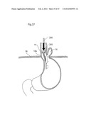 APPARATUS FOR TREATING GERD diagram and image