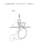 APPARATUS FOR TREATING GERD diagram and image