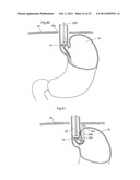 APPARATUS FOR TREATING GERD diagram and image