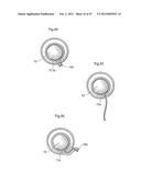 APPARATUS FOR TREATING GERD diagram and image