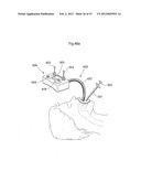 APPARATUS FOR TREATING GERD diagram and image