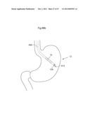 APPARATUS FOR TREATING GERD diagram and image