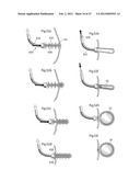 APPARATUS FOR TREATING GERD diagram and image