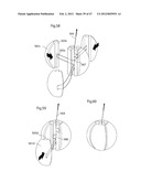 APPARATUS FOR TREATING GERD diagram and image