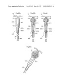 APPARATUS FOR TREATING GERD diagram and image