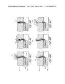 METHOD AND APPARATUS FOR IMPEDING MIGRATION OF AN IMPLANTED OCCLUSIVE     STRUCTURE diagram and image