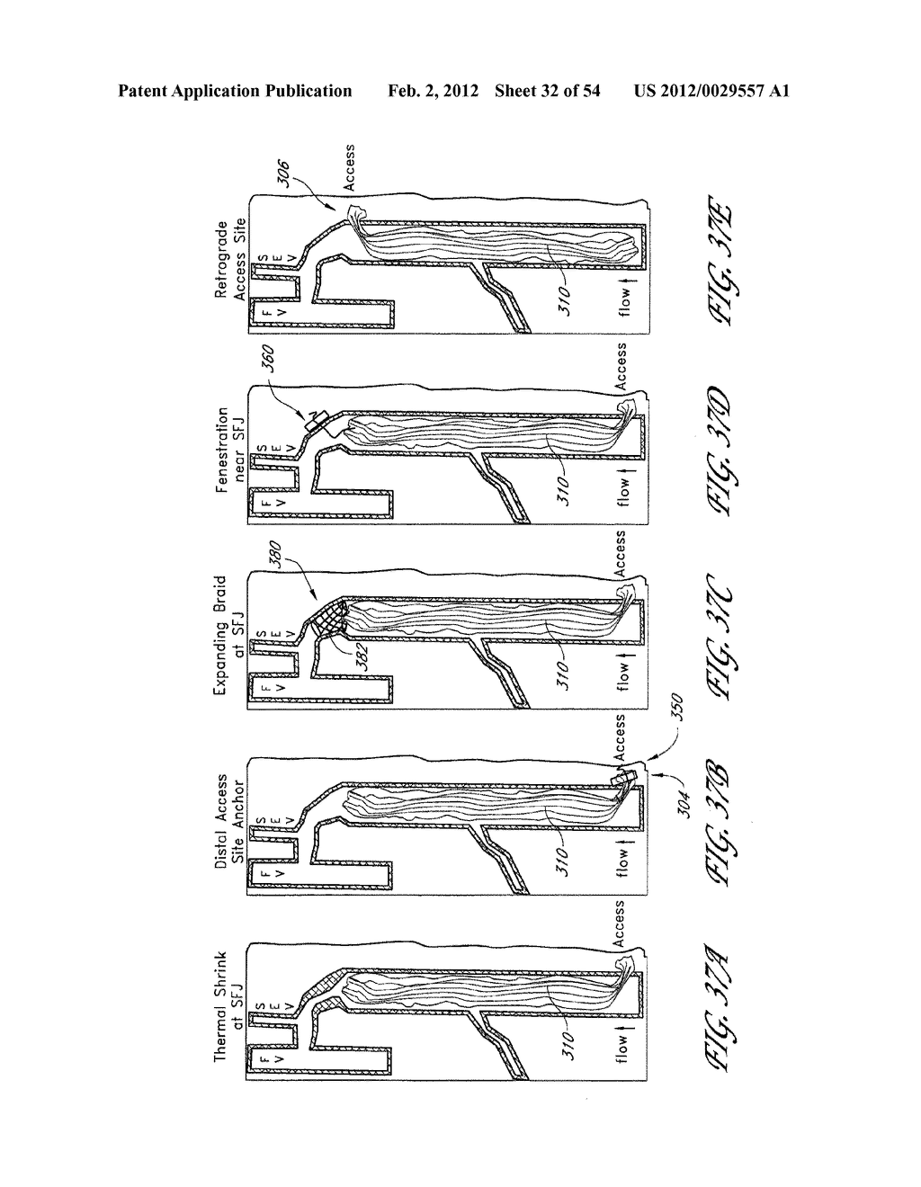 METHOD AND APPARATUS FOR IMPEDING MIGRATION OF AN IMPLANTED OCCLUSIVE     STRUCTURE - diagram, schematic, and image 33