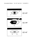 METHOD AND APPARATUS FOR IMPEDING MIGRATION OF AN IMPLANTED OCCLUSIVE     STRUCTURE diagram and image