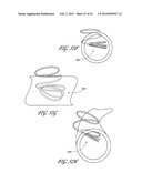 METHOD AND APPARATUS FOR IMPEDING MIGRATION OF AN IMPLANTED OCCLUSIVE     STRUCTURE diagram and image