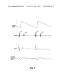 PULSE DETECTION APPARATUS, SOFTWARE, AND METHODS USING PATIENT     PHYSIOLOGICAL SIGNALS diagram and image