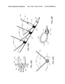 METHOD OF DELIVERING ADVANCED ENDOVASCULAR GRAFT diagram and image