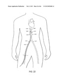 METHOD OF DELIVERING ADVANCED ENDOVASCULAR GRAFT diagram and image