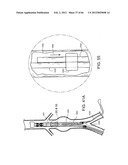 METHOD OF DELIVERING ADVANCED ENDOVASCULAR GRAFT diagram and image