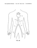 METHOD OF DELIVERING ADVANCED ENDOVASCULAR GRAFT diagram and image