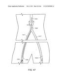 METHOD OF DELIVERING ADVANCED ENDOVASCULAR GRAFT diagram and image