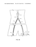 METHOD OF DELIVERING ADVANCED ENDOVASCULAR GRAFT diagram and image