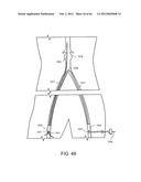 METHOD OF DELIVERING ADVANCED ENDOVASCULAR GRAFT diagram and image