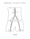 METHOD OF DELIVERING ADVANCED ENDOVASCULAR GRAFT diagram and image