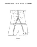 METHOD OF DELIVERING ADVANCED ENDOVASCULAR GRAFT diagram and image