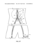 METHOD OF DELIVERING ADVANCED ENDOVASCULAR GRAFT diagram and image