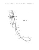 METHOD OF DELIVERING ADVANCED ENDOVASCULAR GRAFT diagram and image