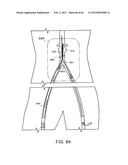 METHOD OF DELIVERING ADVANCED ENDOVASCULAR GRAFT diagram and image